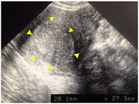Transvaginal ultrasonography a month after fertility-sparing surgery.